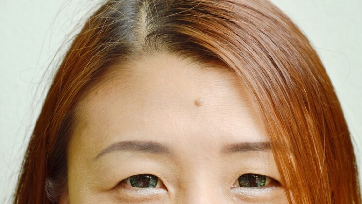 Birthmark On Forehead – Spiritual Meaning